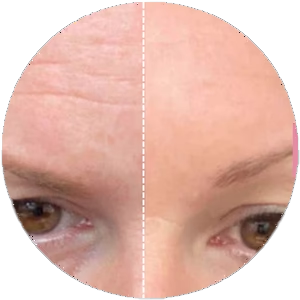 Wrinkles before