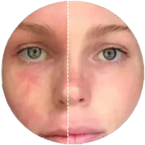 Eczema before