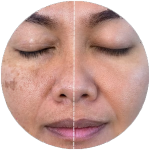 Melasma before
